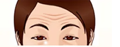 眼瞼下垂の特徴