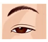 眼瞼下垂の開眼状態