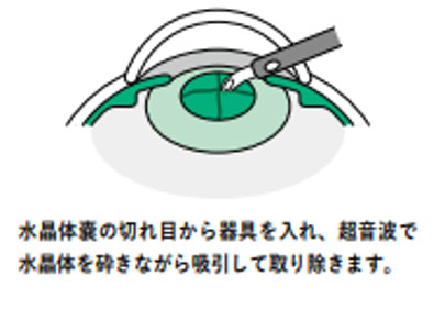 白内障手術について